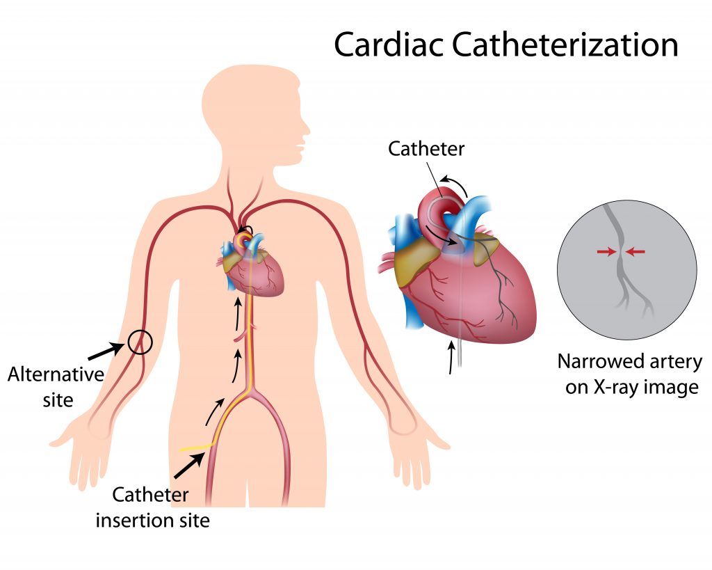 Expert Insights on Cardiac Catheterization