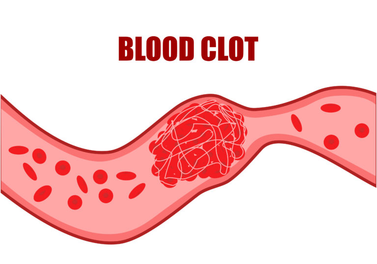 Expert Blood Clotting Disorder Care & Treatment CVG Cares Cardiology