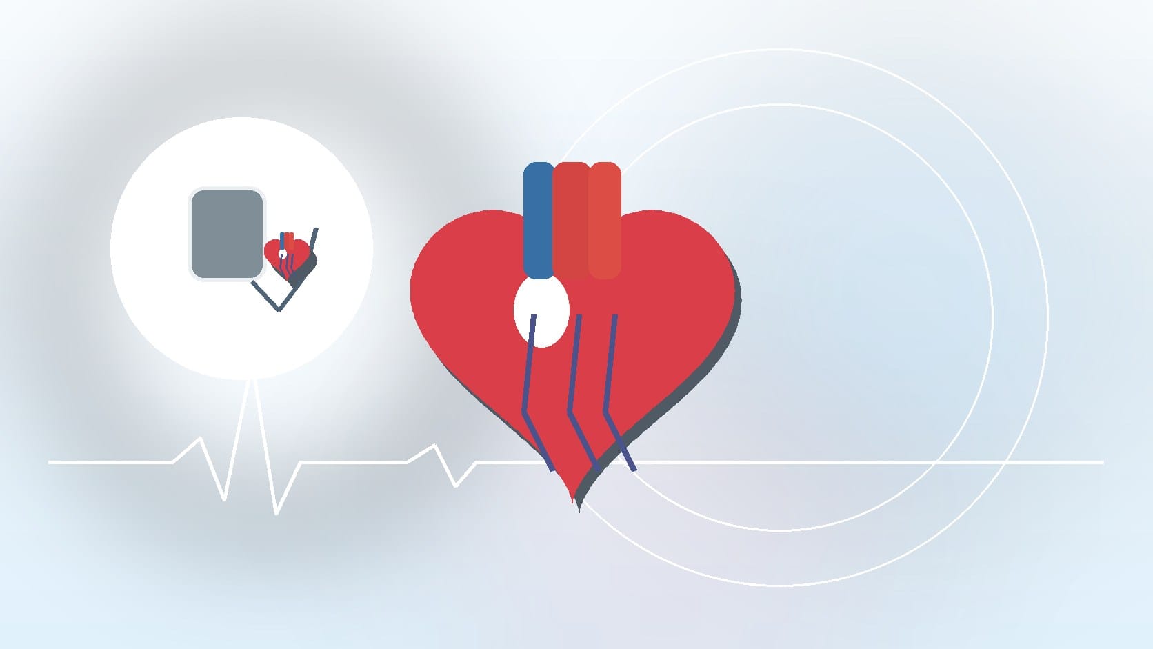 5 Things You Should Know About Atrial Fibrillation
