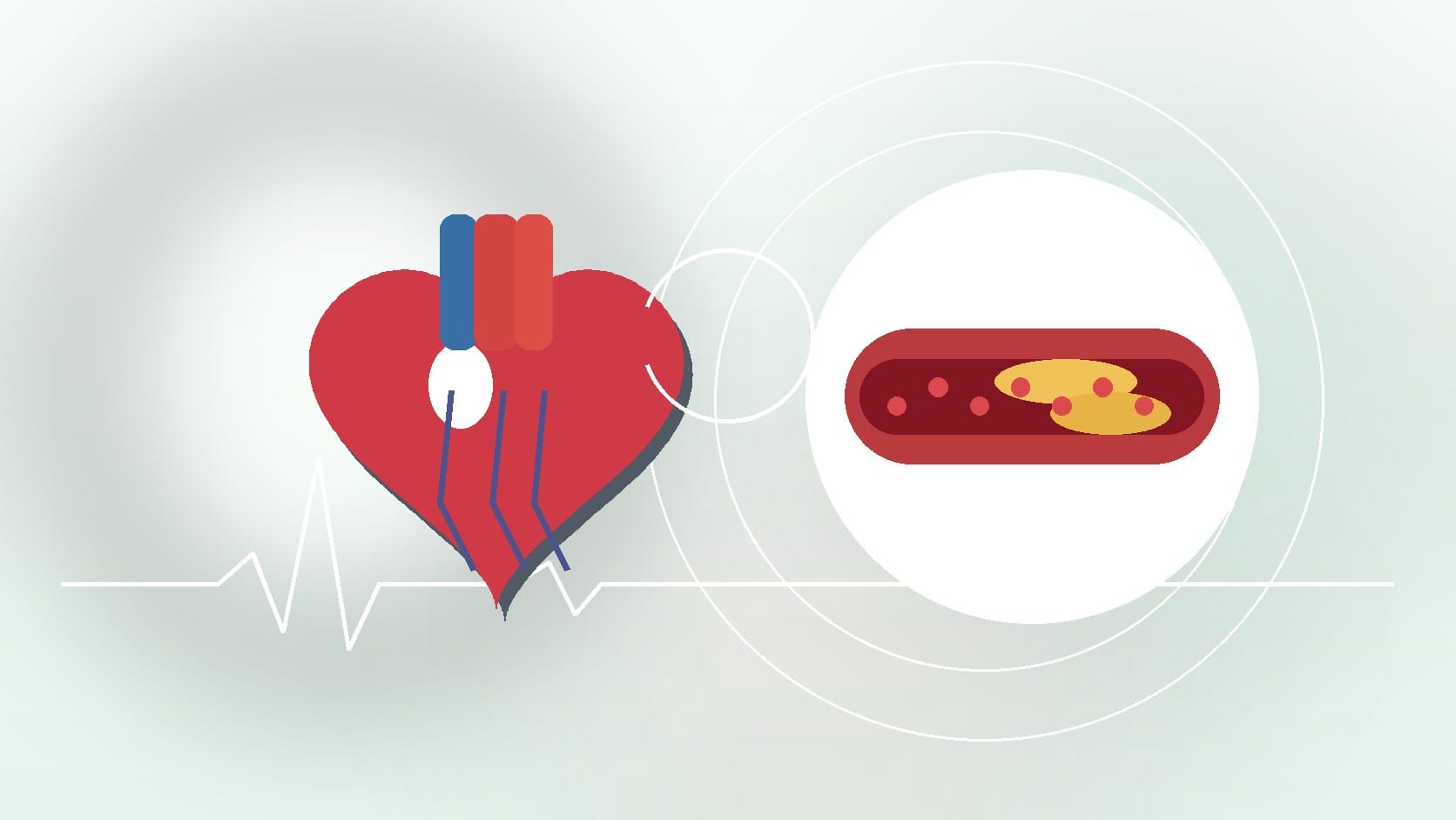 What Causes Calcification of Arteries? Risk Factors and Prevention