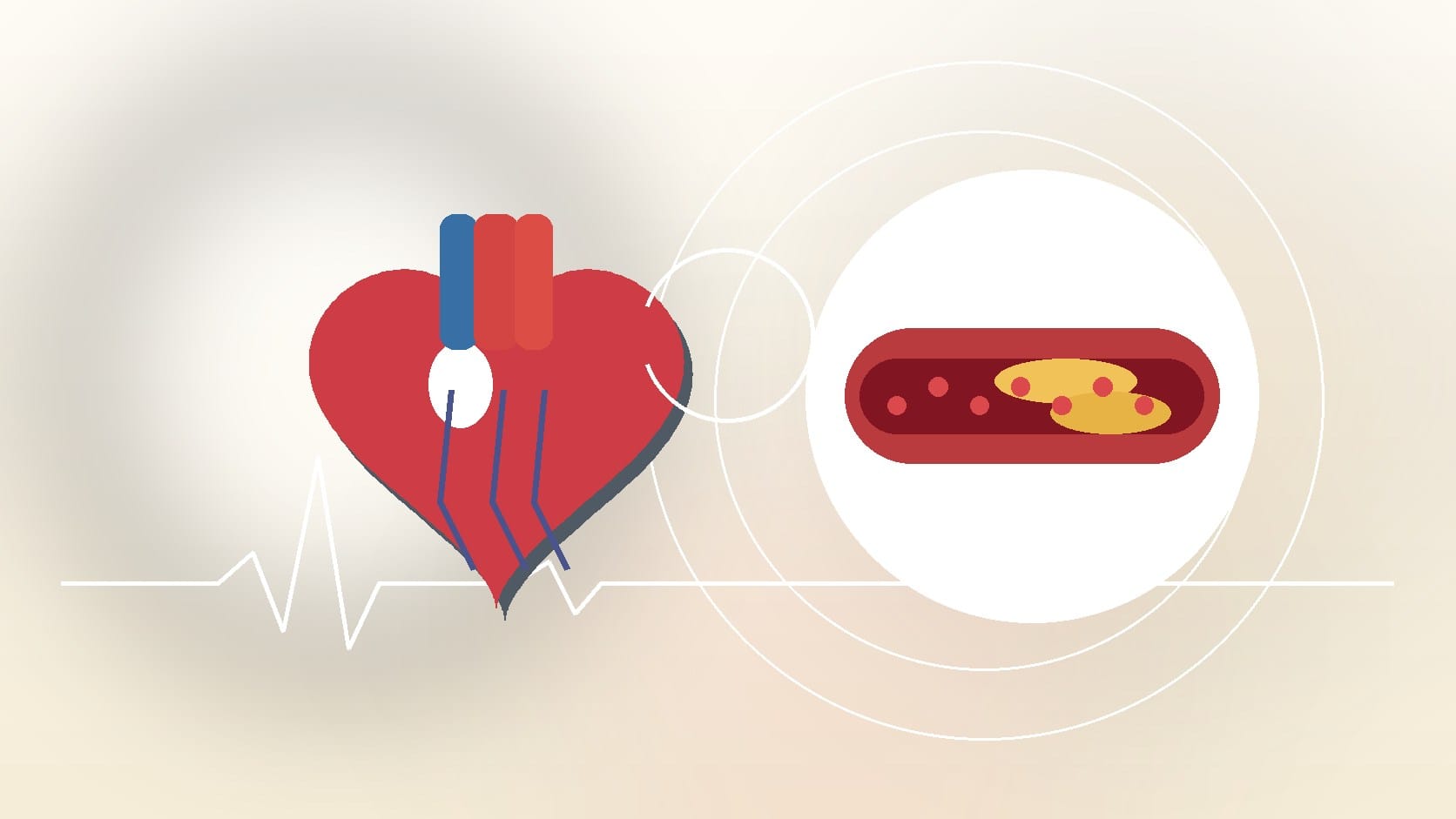 New Prevention Guidelines for Cardiac Arrest
