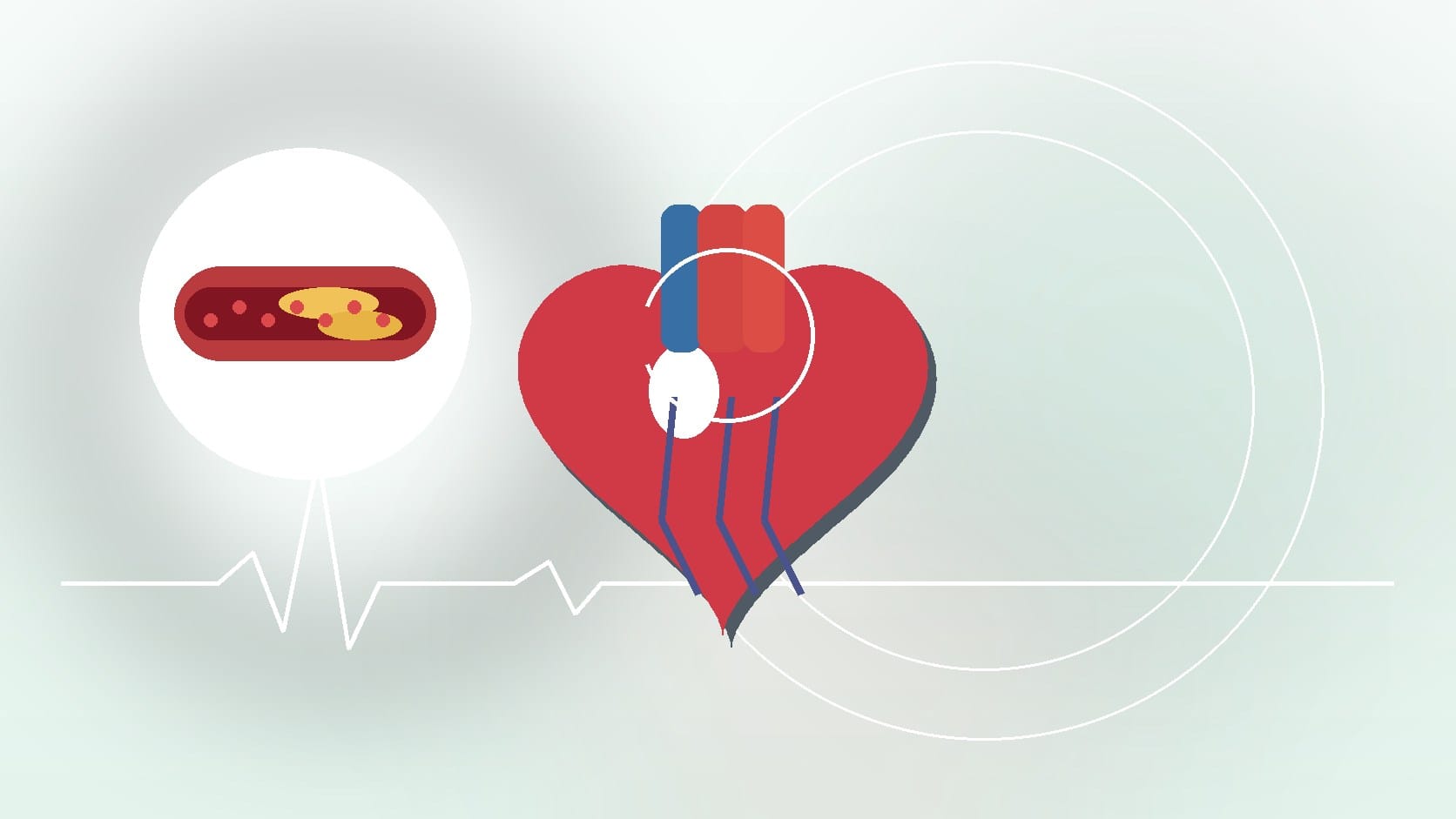 Cholesterol Explained: Heart Disease Prevention