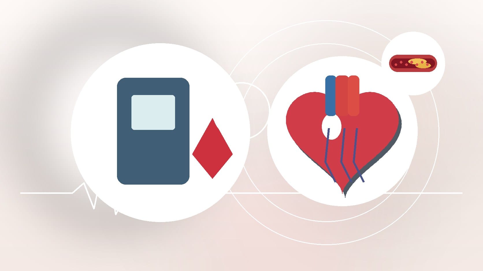 Diabetes Prevention Could Mean Heart Disease Prevention