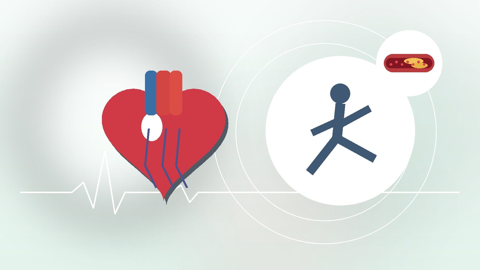 Exploring The Different Types Of Catheter Ablation By Cardiovascular Group: A Comprehensive Overview