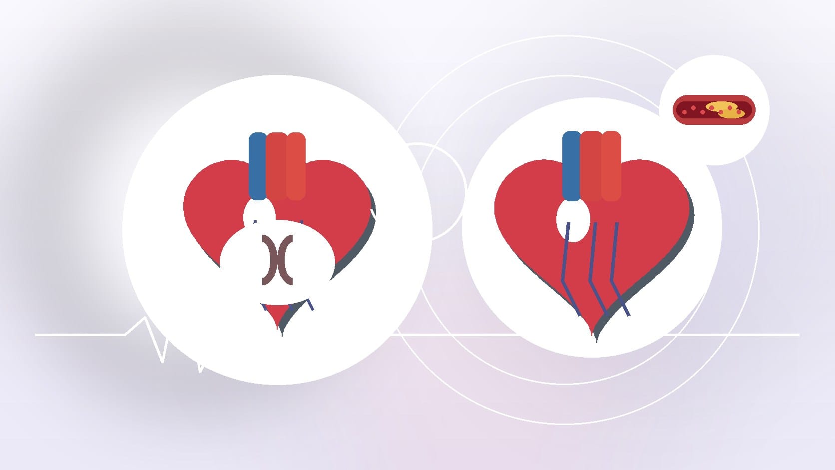 Heart Murmurs: Risk Factors for Heart Attack