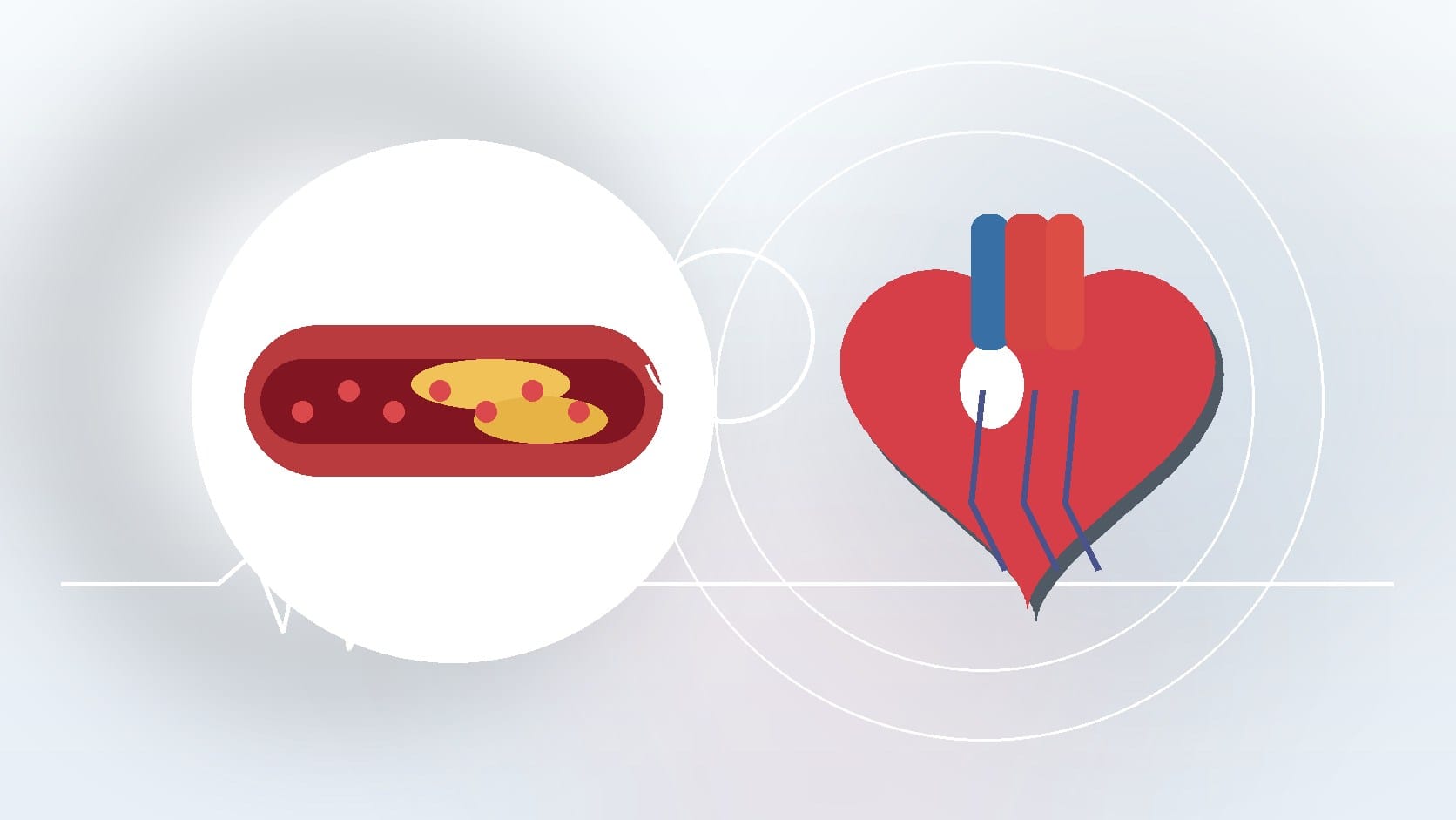How Serious Is Severe Coronary Artery Calcification? Understanding the Risks and Treatment Options