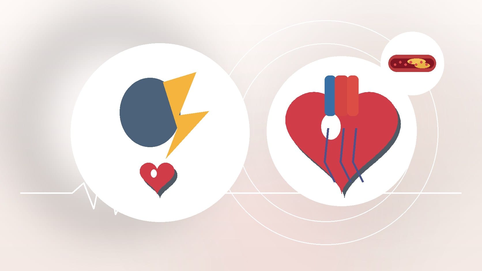 Stress Disorders May Be Linked To Heart Disease