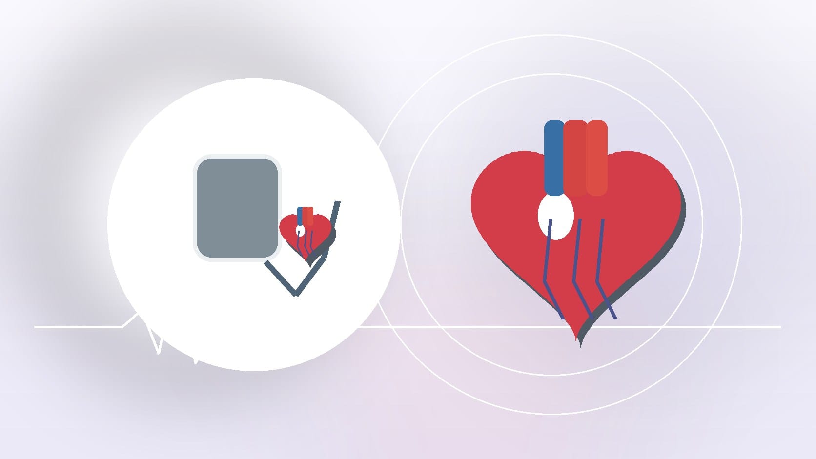 What is Supraventricular Tachycardia?