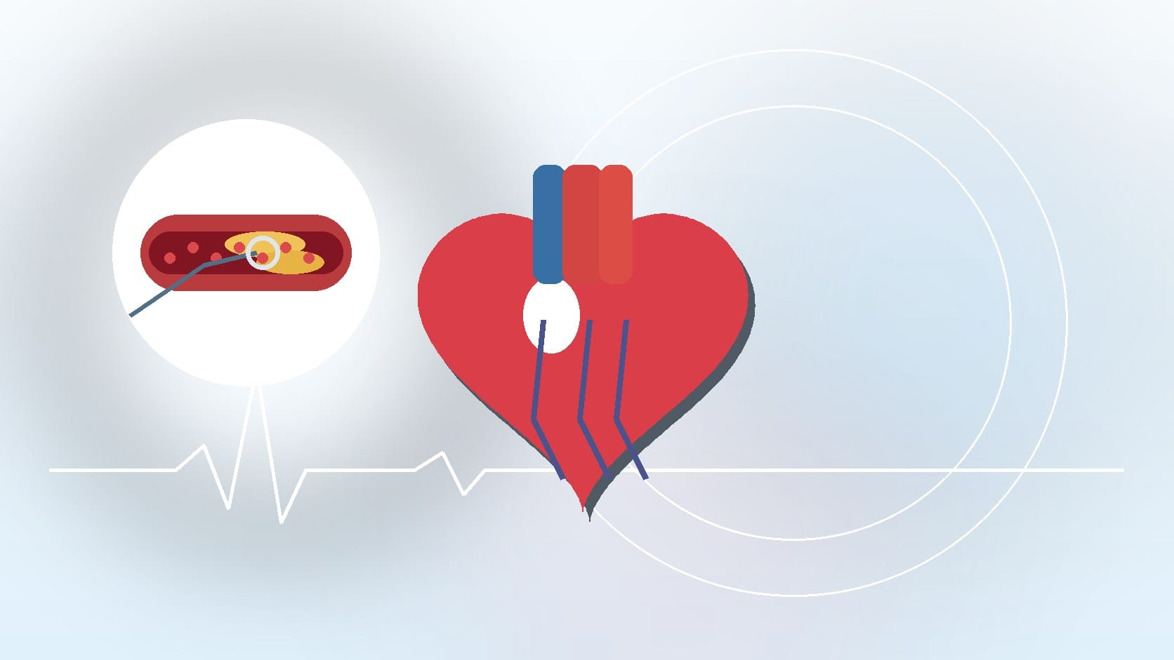 The Purpose of Heart Catheterization: Why It's Done and What to Expect