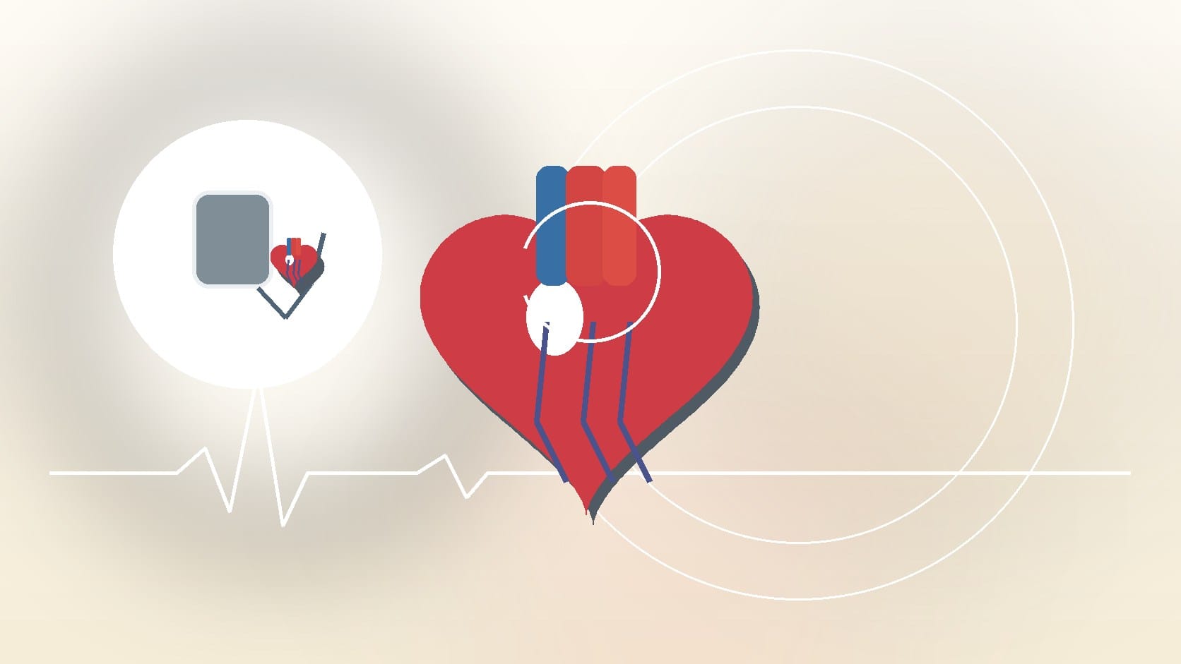 Watchman Device Succeeds in Stroke Prevention