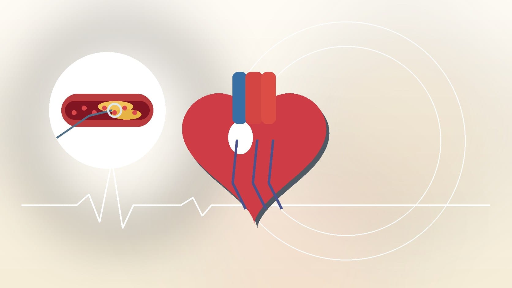 What Is a Heart Cath Procedure? Step-by-Step Guide