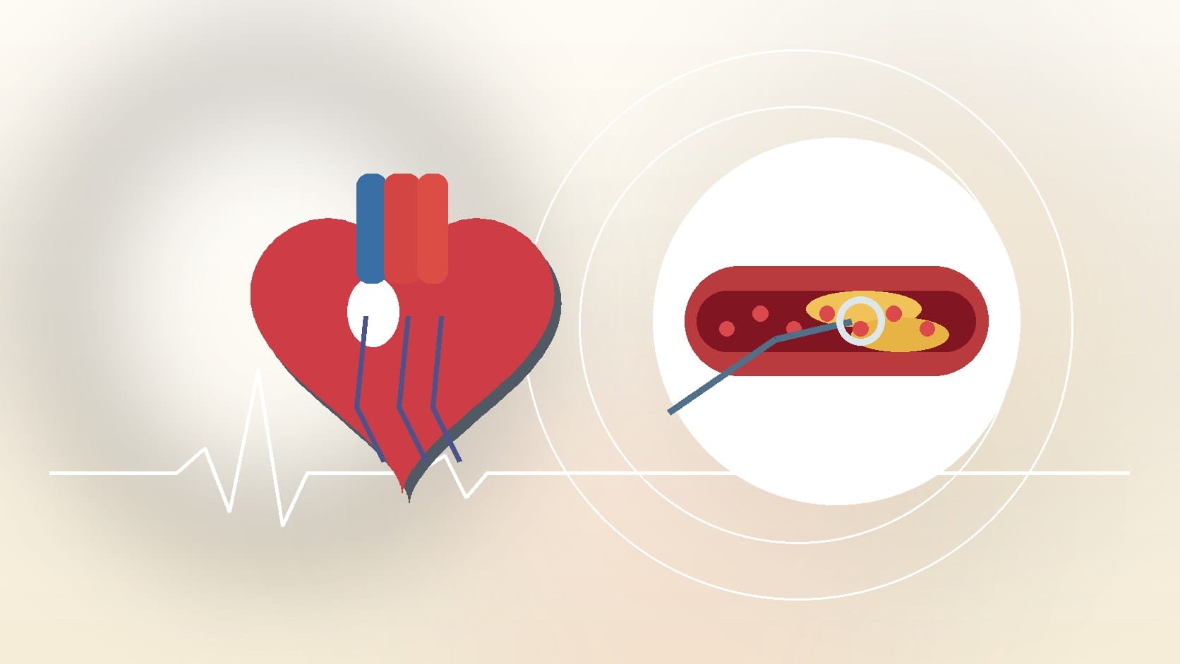What to Expect During a Cardiac Electrophysiology Procedure