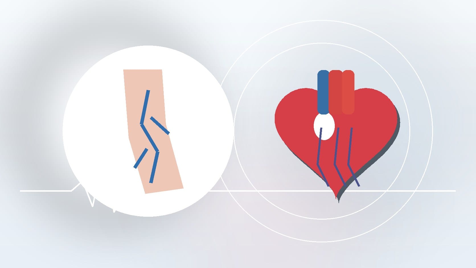 CVG Insights: What Causes Varicose Veins?