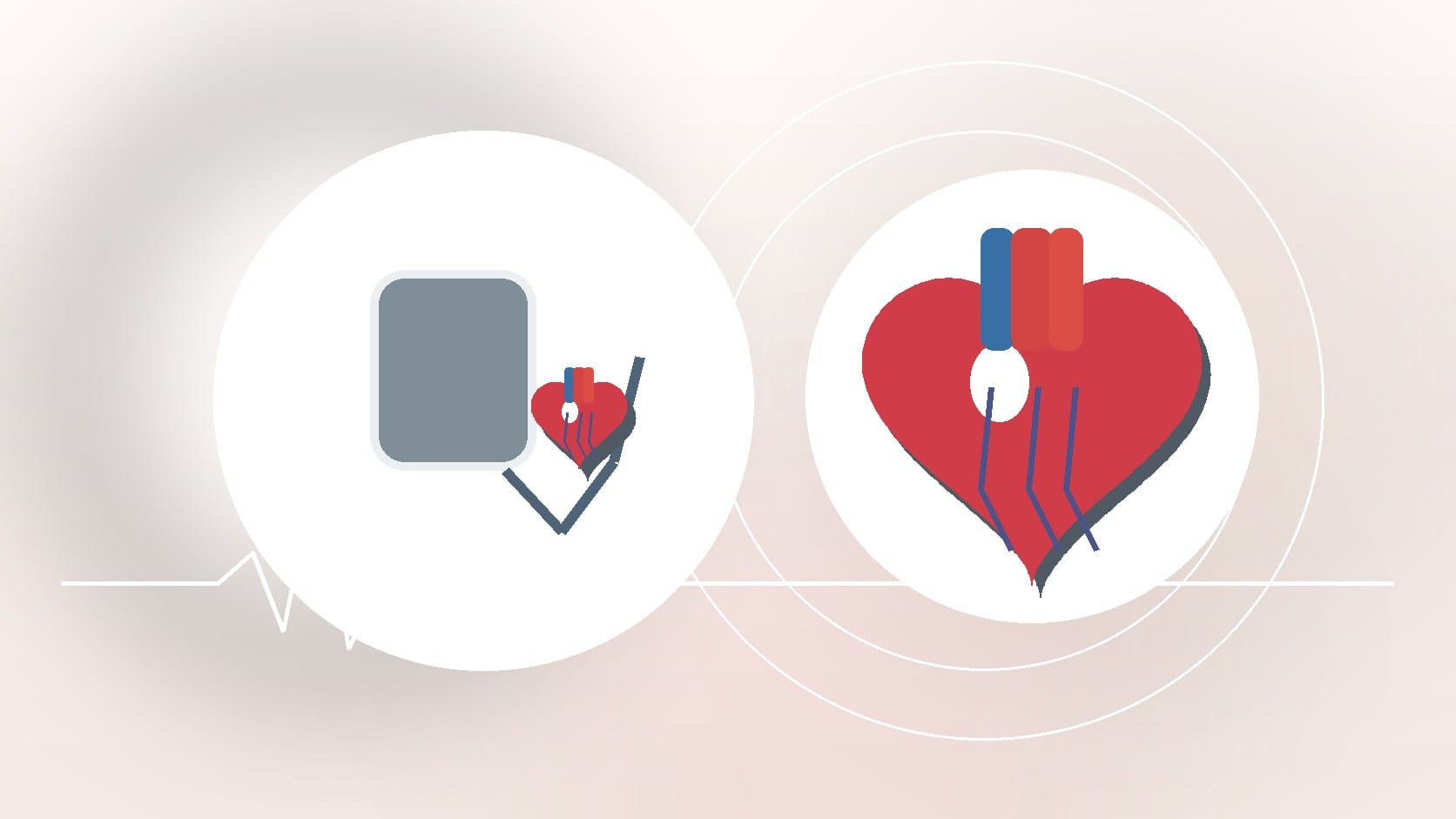 What’s the Best Blood Thinner for Afib?